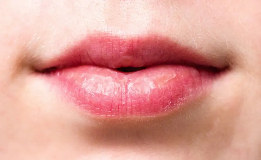 Labios quemados por el sol - cómo aliviar y cuándo consultar