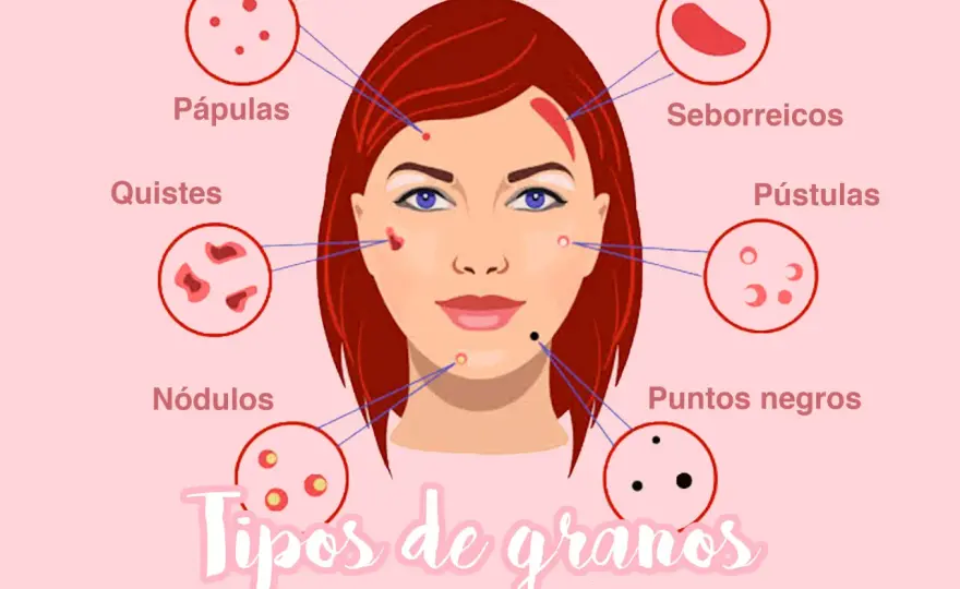 Granos en la cara - causas, tipos y cómo tratarlos