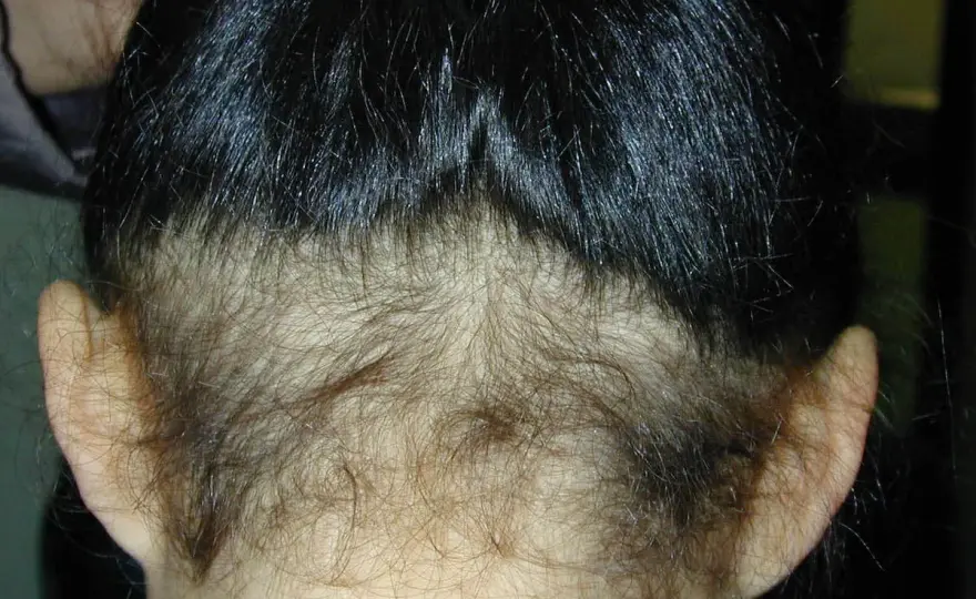 Poca densidad de pelo - causas y tratamientos eficaces