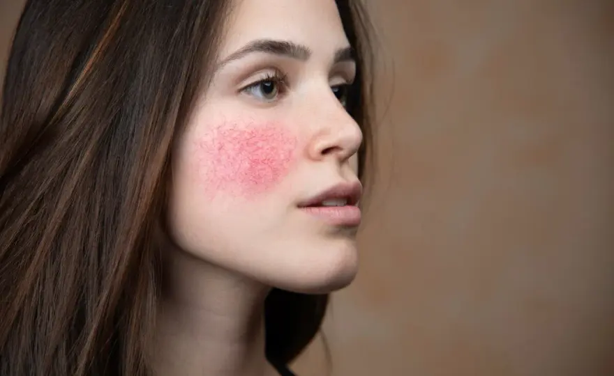 Rubor facial - causas, cuidados y cuándo consultar