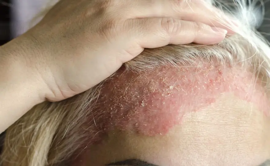 Dermatitis en la cara - tipos, causas y cuándo consultar
