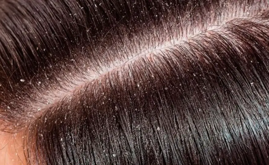 Tipos de caspa en la cabeza y cuándo consultar al dermatólogo