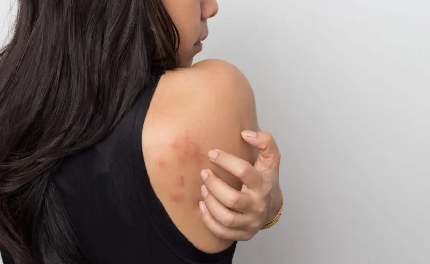 Ronchas rojas que pican - cómo reconocer la urticaria