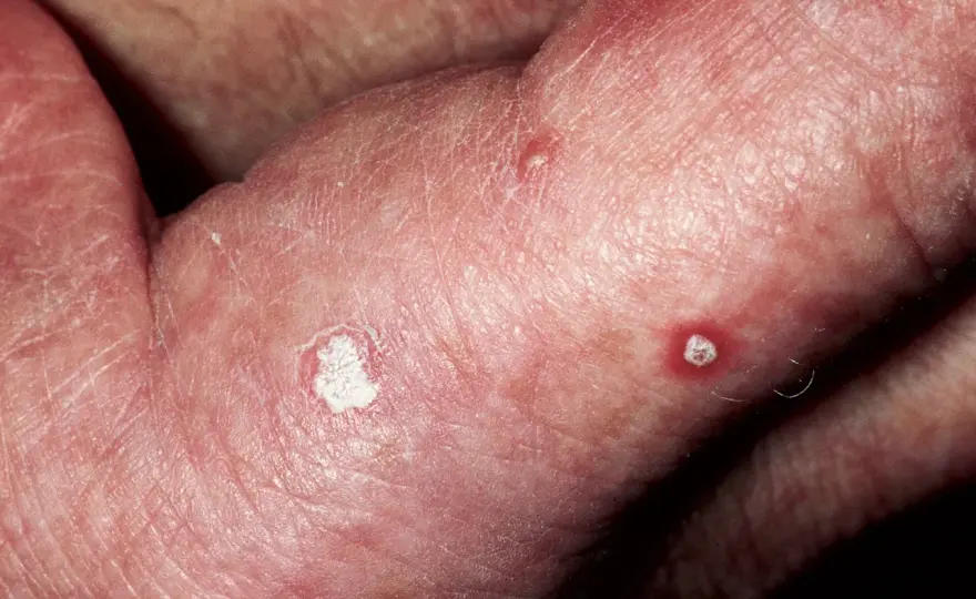 Queratosis actínica, cómo reconocerla y cuándo consultar