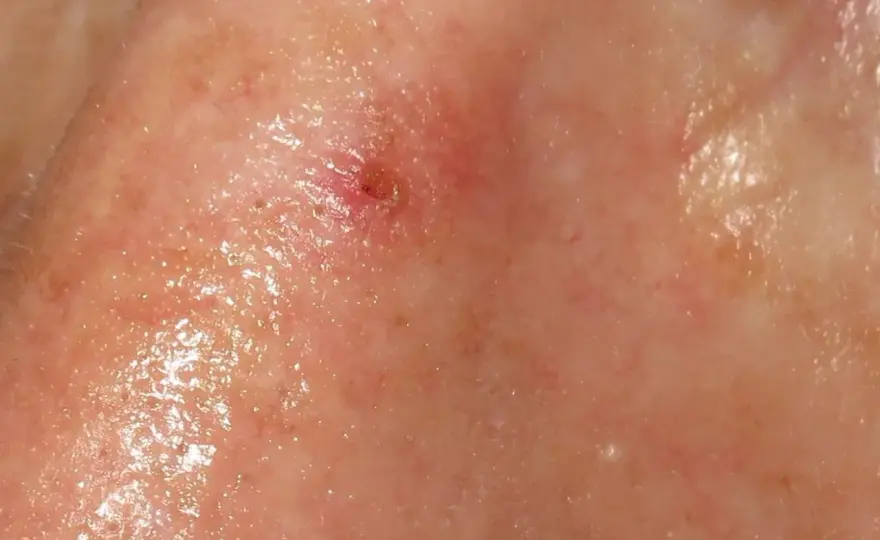 Queratosis actínica en la nariz - señales y tratamientos