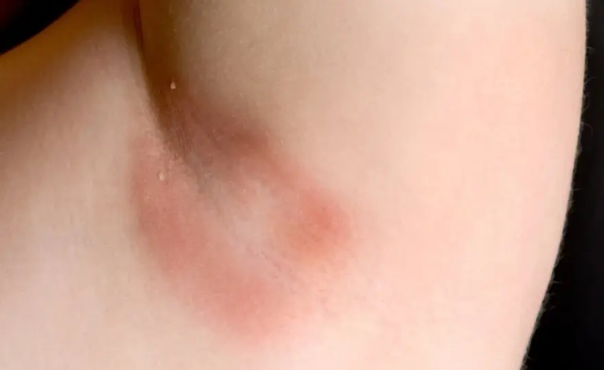 Acantosis nigricans, cómo tratarla sin empeorar la piel