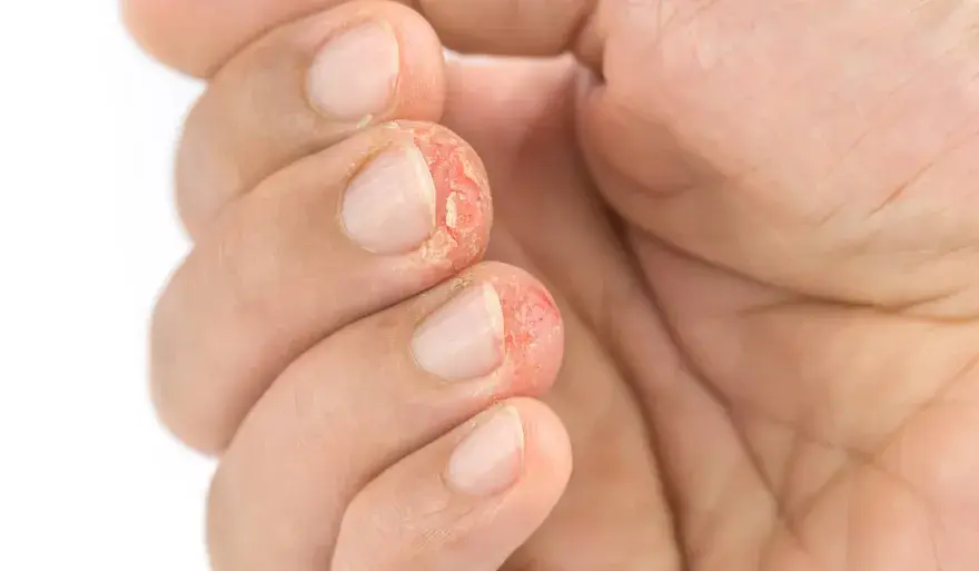Dishidrosis de la mano - cómo reconocerla y controlar los brotes