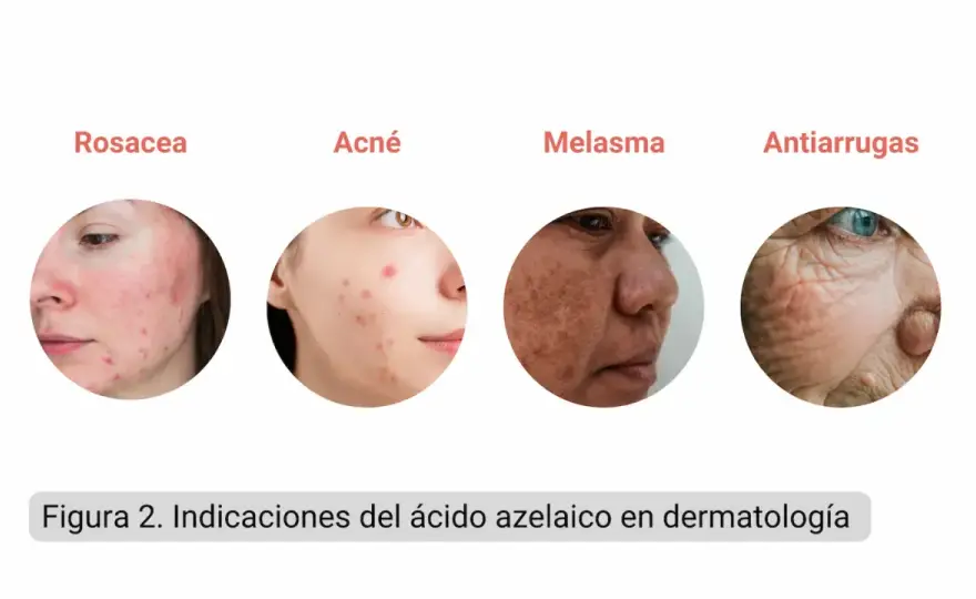 Ácido azelaico para acné, rosácea y manchas - cómo usarlo