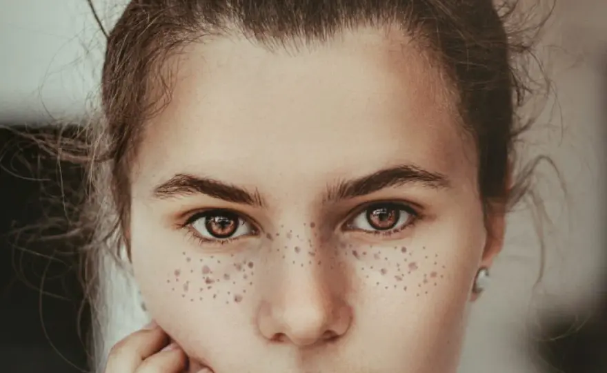 Lunar facial ¿cuándo revisarlo y cómo quitarlo?