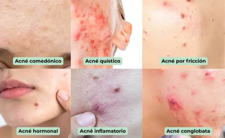 Tipos de acné y cuándo consultar con Dermatología