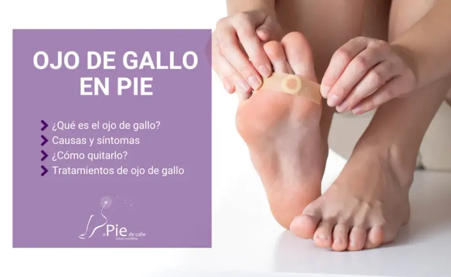 Ojo de gallo en el pie - cómo aliviarlo y evitar que vuelva