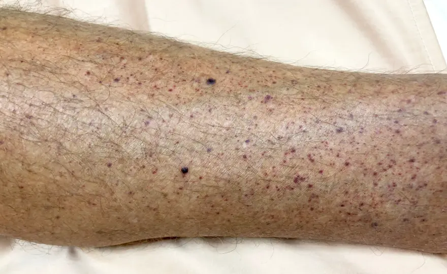 Fotos de manchas en las piernas - causas y señales de alarma