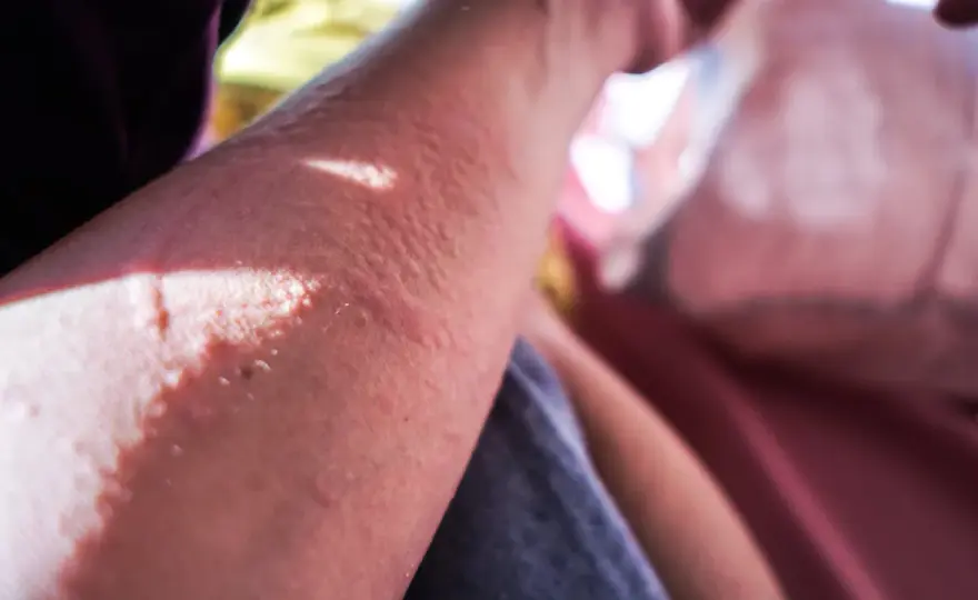 Alergia al sol - causas, síntomas y cómo prevenir brotes