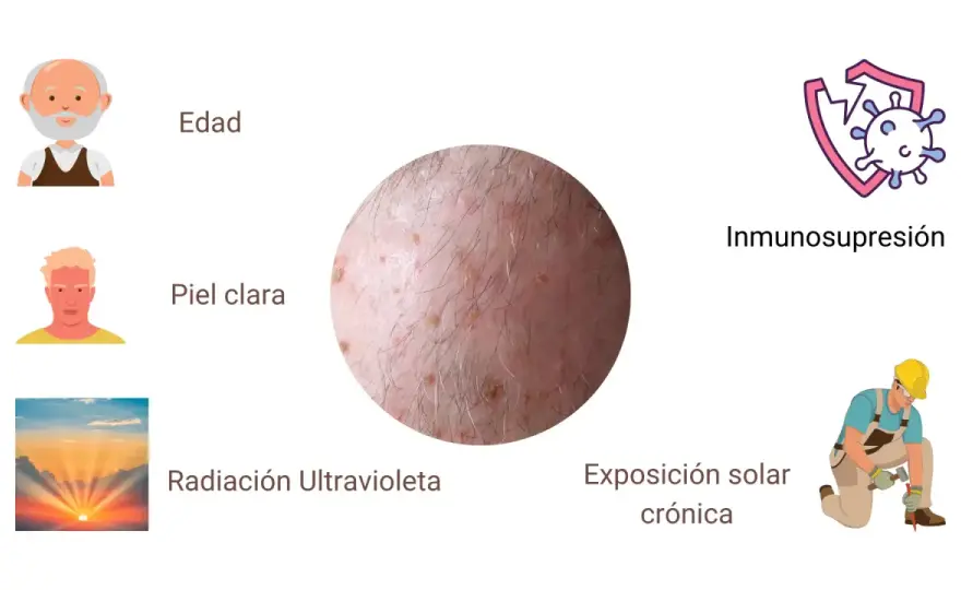 Queratosis actínica - señales, tratamientos y prevención