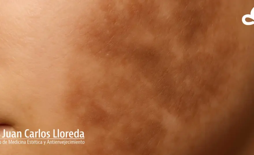 Hiperpigmentación postinflamatoria - cómo aclarar las manchas
