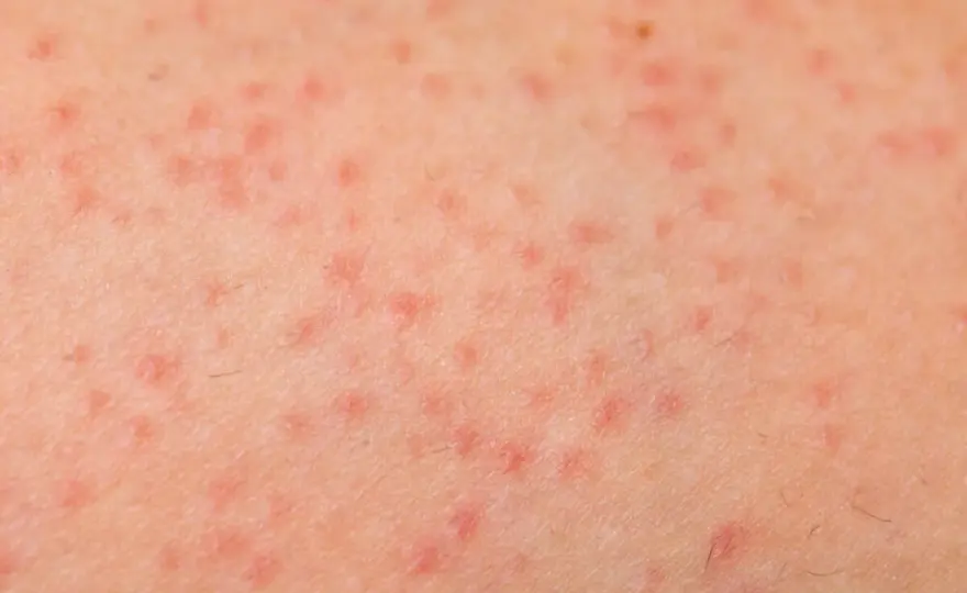 Queratosis pilaris - cómo suavizar la piel áspera