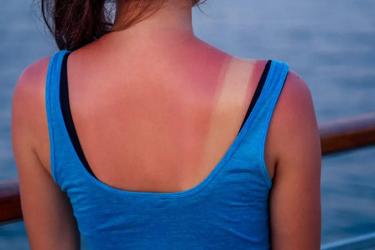 Espalda con piel quemada por el sol, mostrando un bronceado desigual y enrojecimiento.