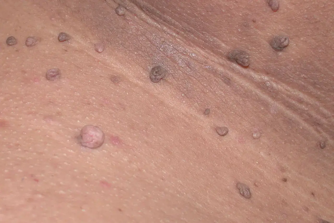 Primer plano de verrugas en las axilas, algunas de ellas con aspecto carnoso y otras más pequeñas y oscuras.