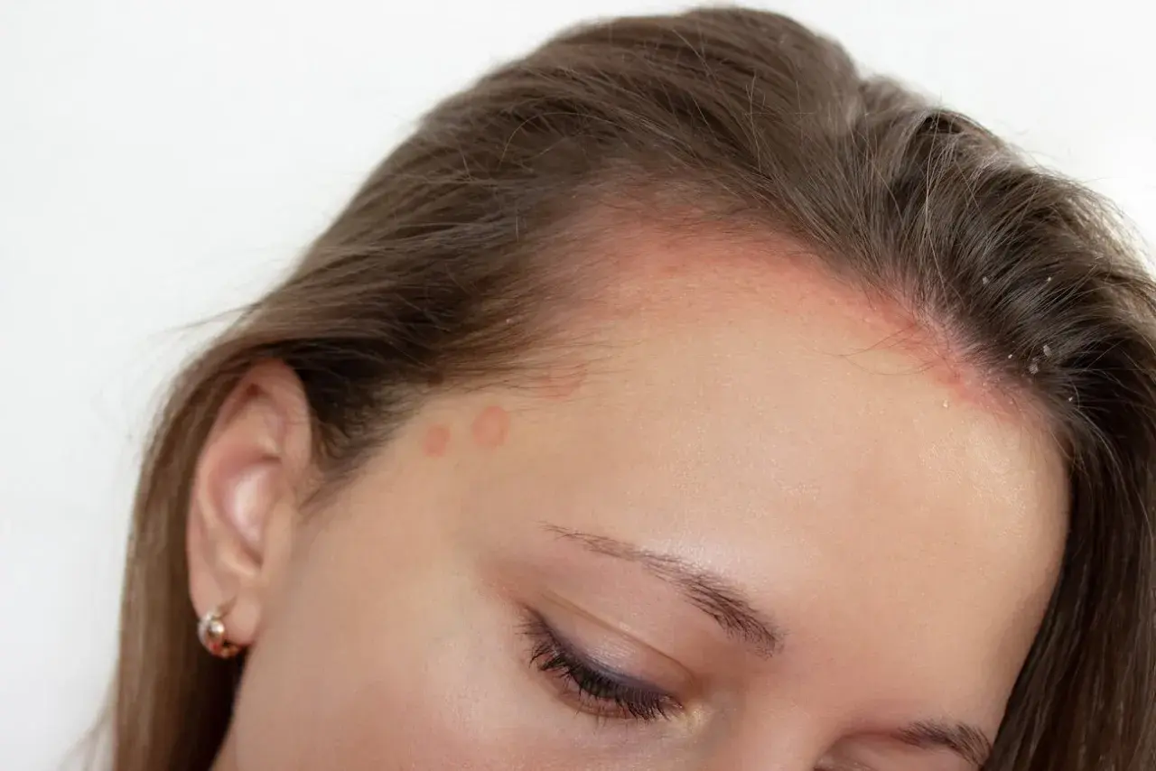 Piel enrojecida y escamosa en la frente y línea del cabello, con anillos rojos en la sien. Posible dermatitis seborreica, buscando tratamiento.