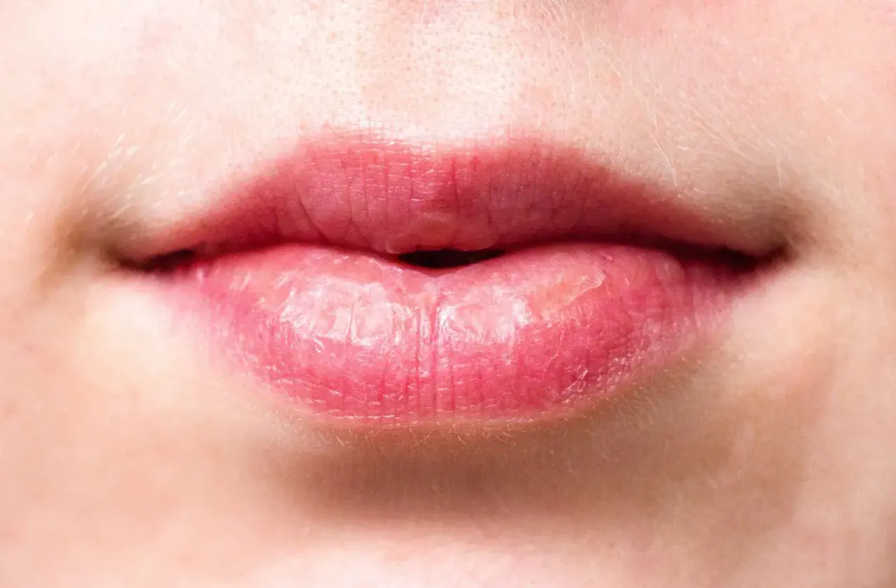 Labios rojos y agrietados, con aspecto de labios quemados por el sol, mostrando sequedad y descamación.