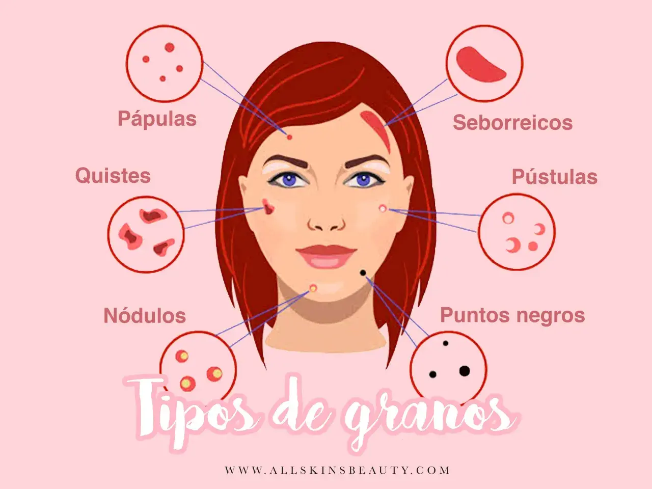 Ilustración que muestra diferentes tipos de granos en la cara: pápulas, quistes, nódulos, seborreicos, pústulas y puntos negros.