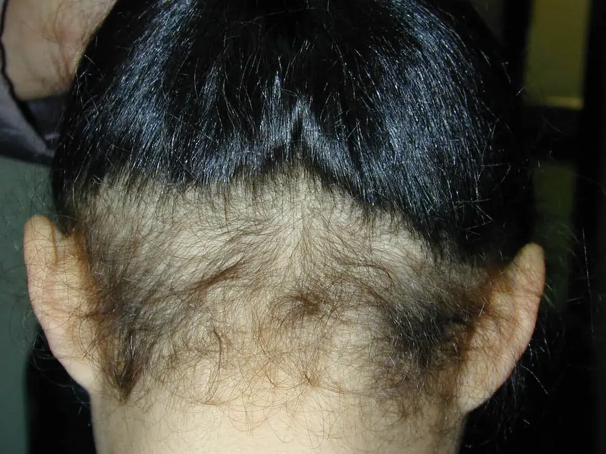 Vista posterior de una cabeza con cabello oscuro y lacio, mostrando una zona de poca densidad de pelo en la nuca y alrededor de las orejas.