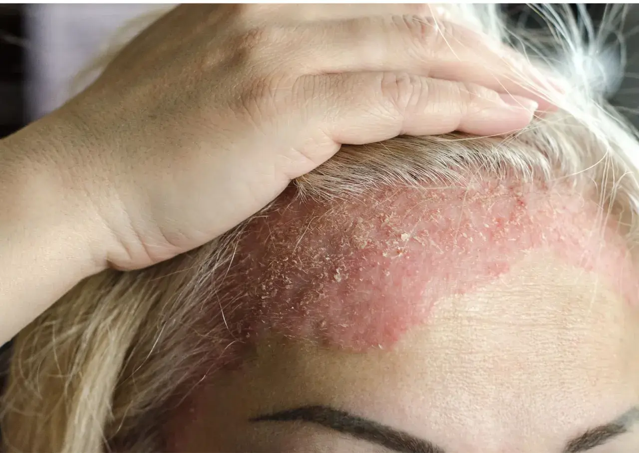 Una mano toca la frente de una mujer con dermatitis en la cara, mostrando piel enrojecida y escamosa.