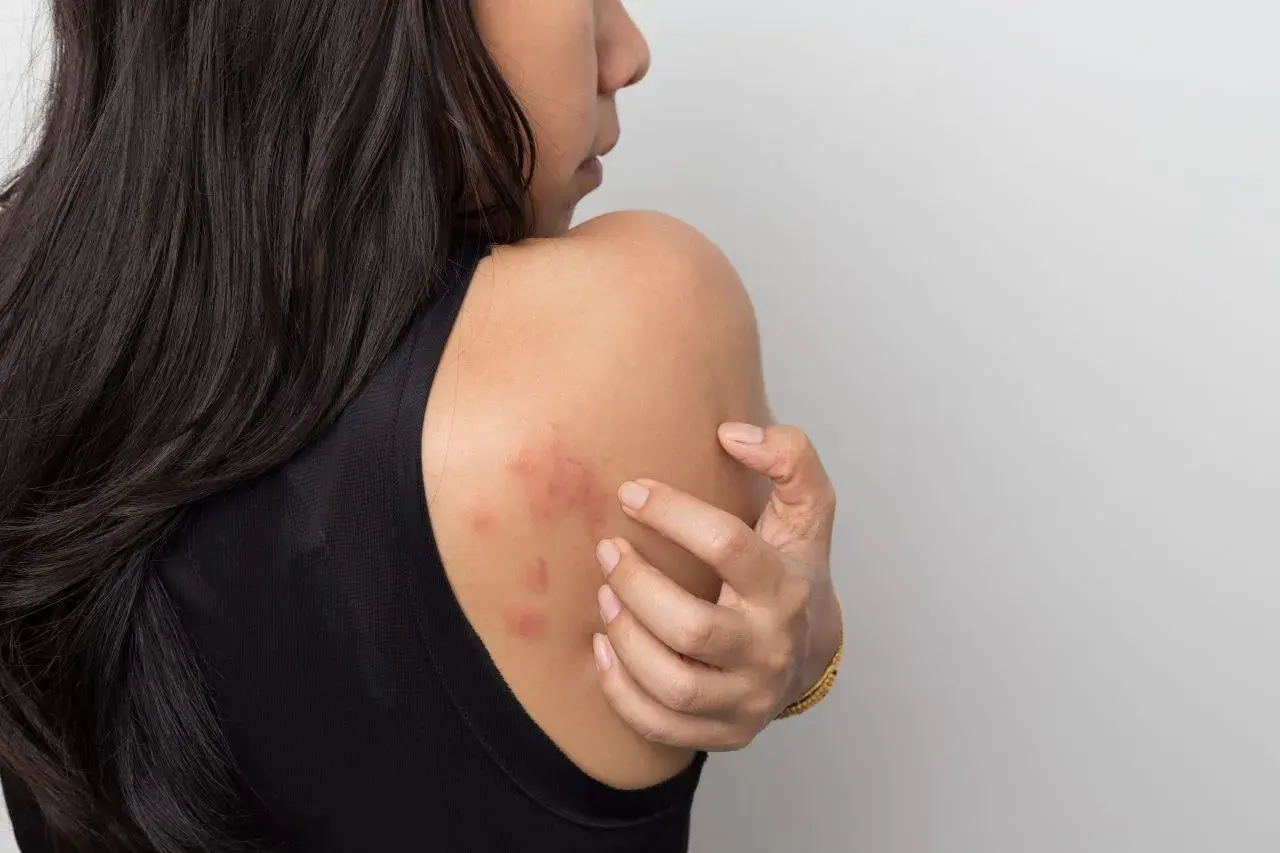 Mujer se rasca el hombro, mostrando ronchas rojas en la piel que pican.