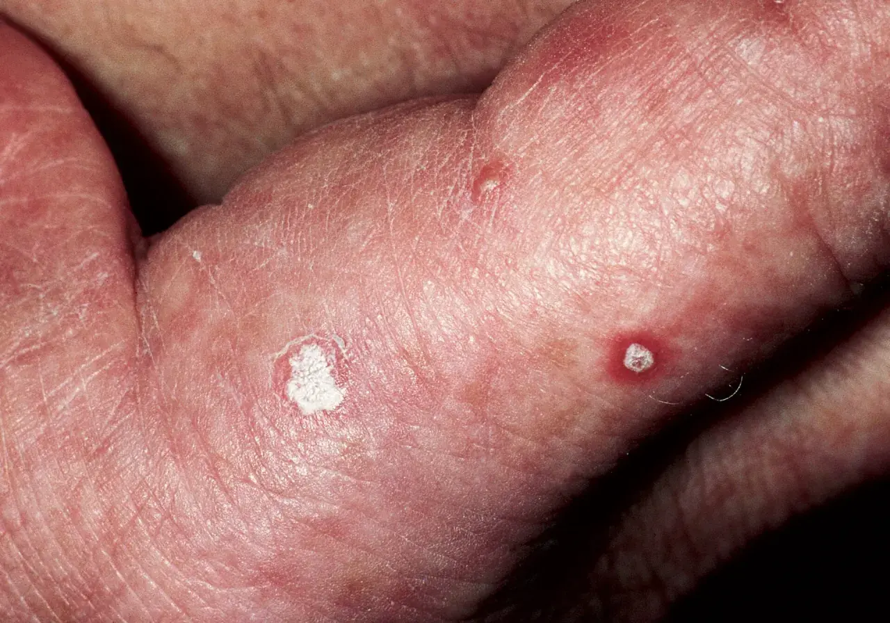 Piel enrojecida con escamas blancas y pequeñas lesiones, indicativas de queratosis solar.