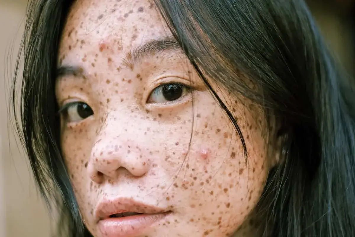 Primer plano de una joven con pecas y una mancha abultada en la cara, con cabello oscuro cayendo sobre su rostro.