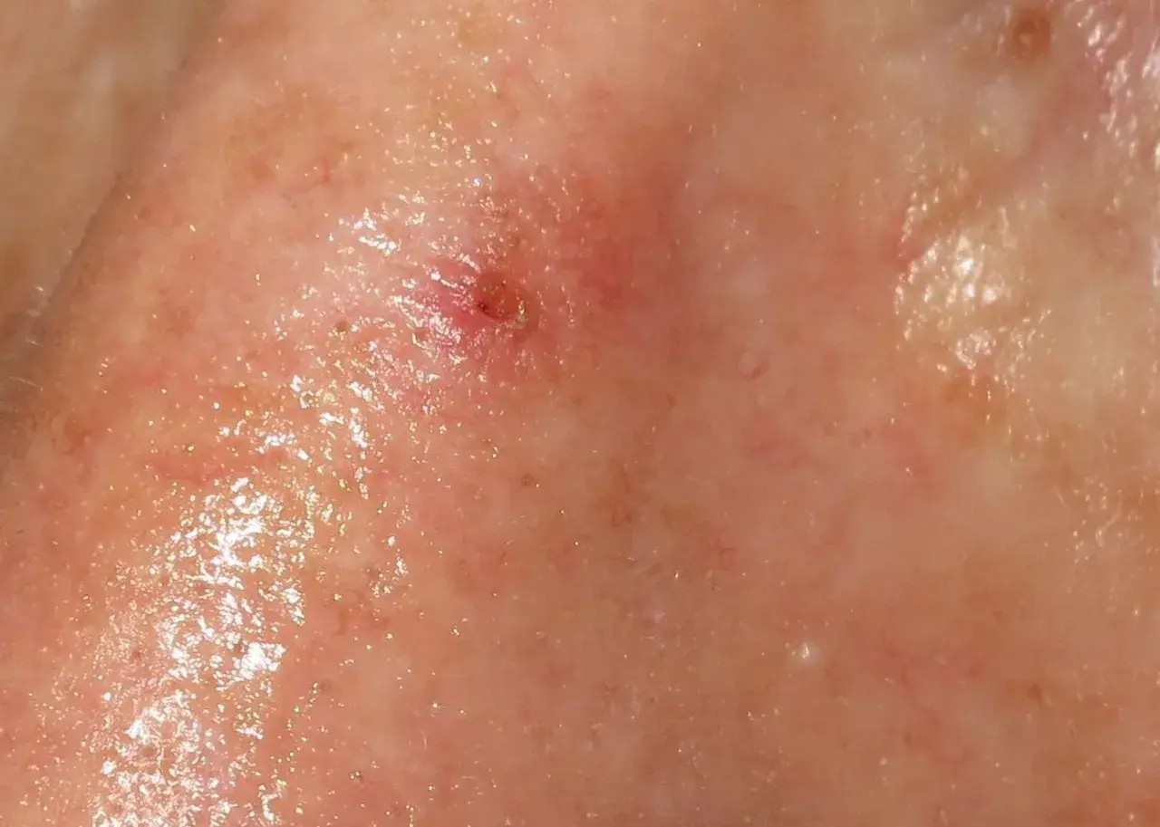 Lesión cutánea en la nariz, posiblemente queratosis actínica, con enrojecimiento y descamación.