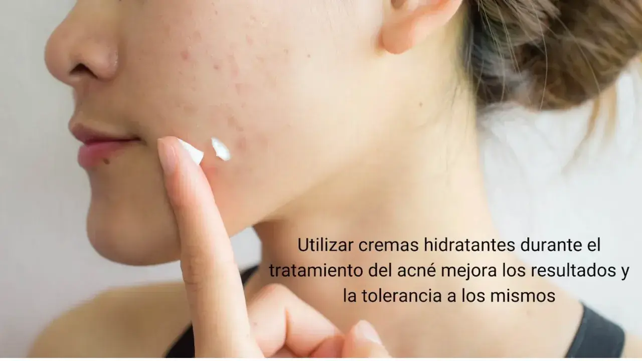 Una persona aplica crema hidratante en su rostro con acné. Es bueno echarse crema hidratante en los granos para mejorar el tratamiento.