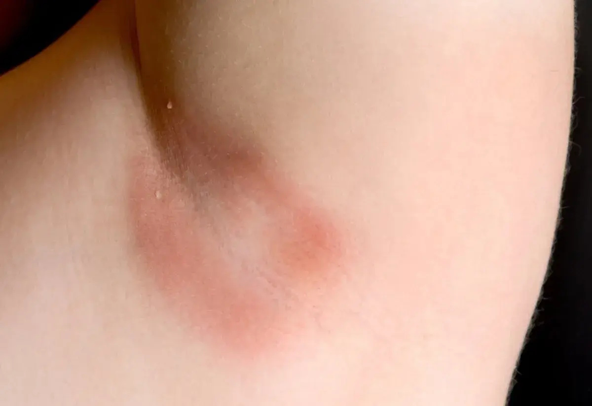 Axila con piel enrojecida y engrosada, indicativo de acantosis nigricans. El tratamiento busca mejorar la apariencia y salud de la piel.