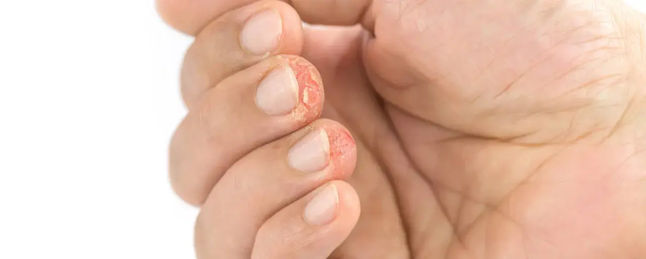 Dedos con piel agrietada y enrojecida, síntoma de dishidrosis mano.