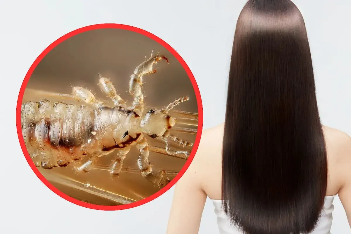 Primer plano de un piojo en un cabello liso y oscuro. Los piojos saltan y se reproducen rápidamente.