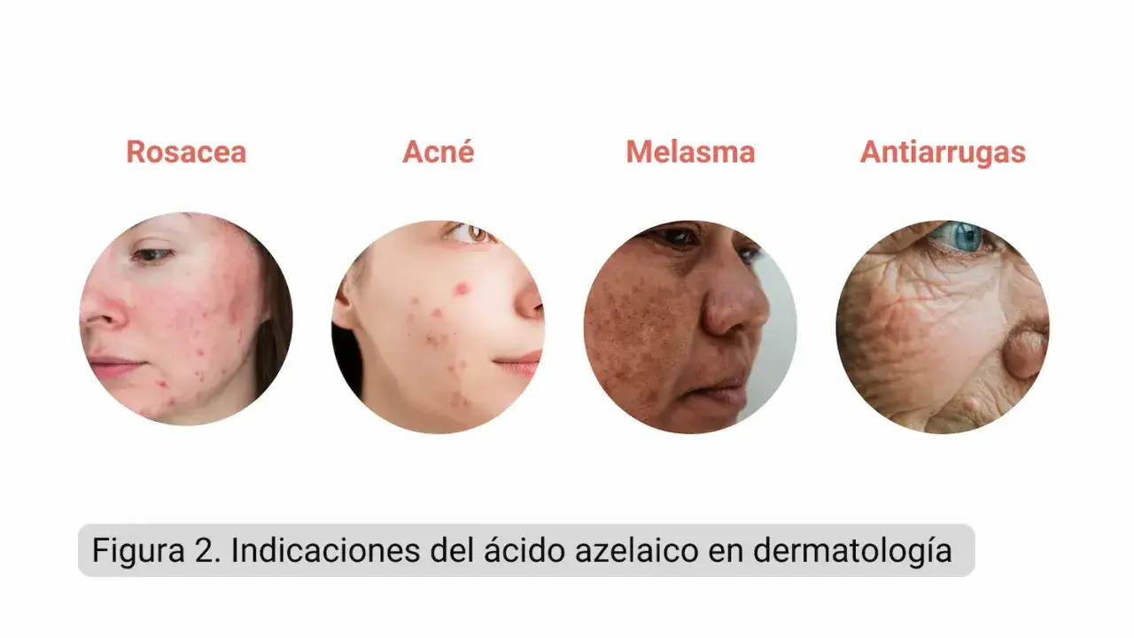 El ácido azelaico sirve para tratar rosácea, acné, melasma y arrugas. Muestra rostros con estas afecciones.