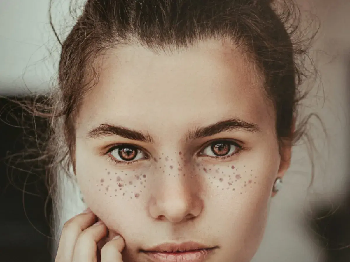 Primer plano de una joven con hermosos lunares en la cara, su mirada es cautivadora.