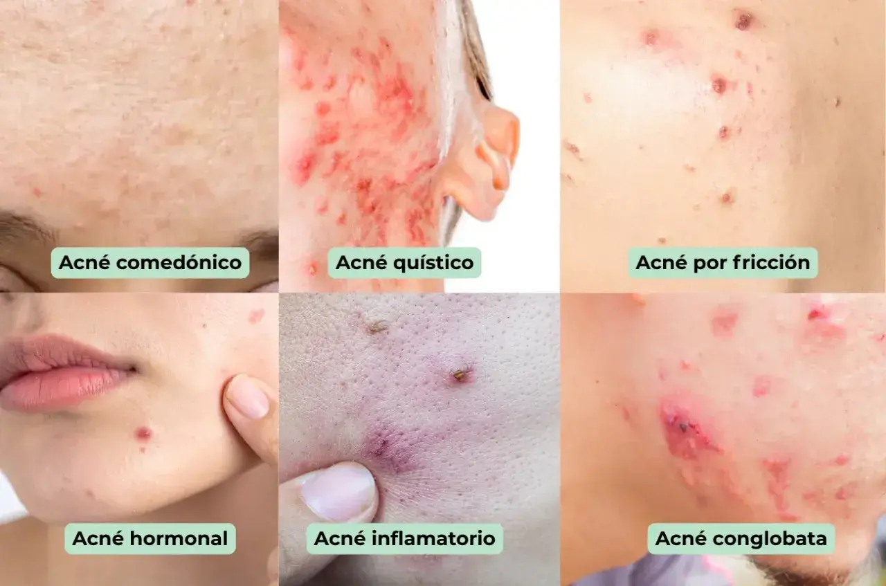 Seis imágenes muestran diferentes tipos de acné: comedónico, quístico, por fricción, hormonal, inflamatorio y<bos> conlobata.
