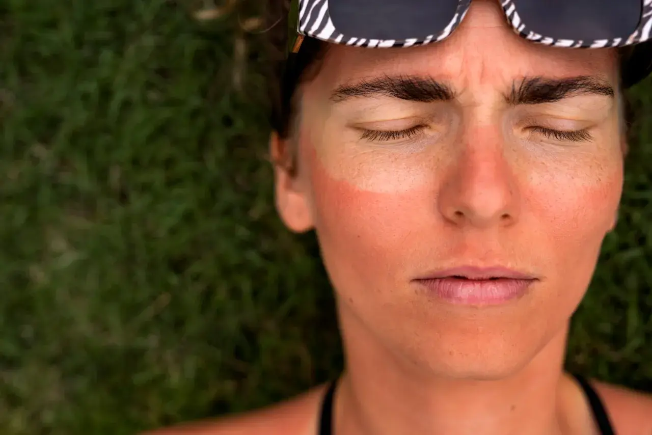 Rostro de mujer con los ojos cerrados, mejillas enrojecidas por el sol y gafas de sol con estampado de cebra. Evidencia de fotoenvejecimiento por el sol.