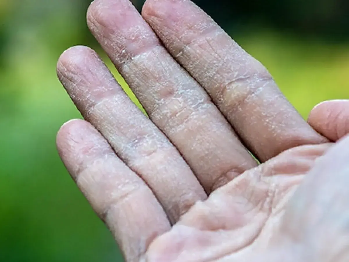 Dedos con piel seca y agrietada, mostrando síntomas de eccema dishidrótico.