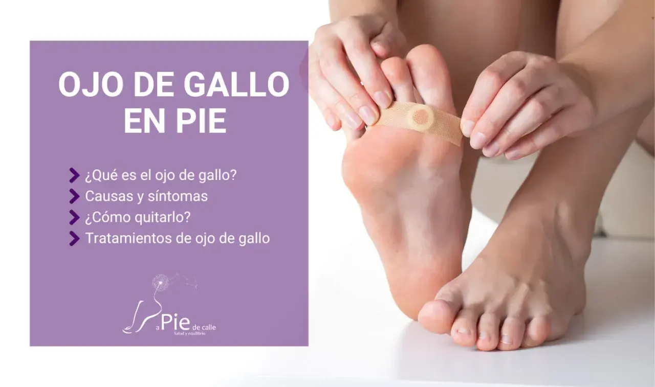 Persona aplica un parche para tratar un ojo de gallo en el pie. El texto indica "Ojo de gallo en pie" y ofrece información sobre causas, síntomas y tratamientos.