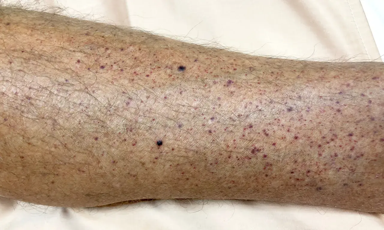Primer plano de la piel de una pierna con numerosos puntos rojos y morados, mostrando diferentes tipos de manchas en las piernas.
