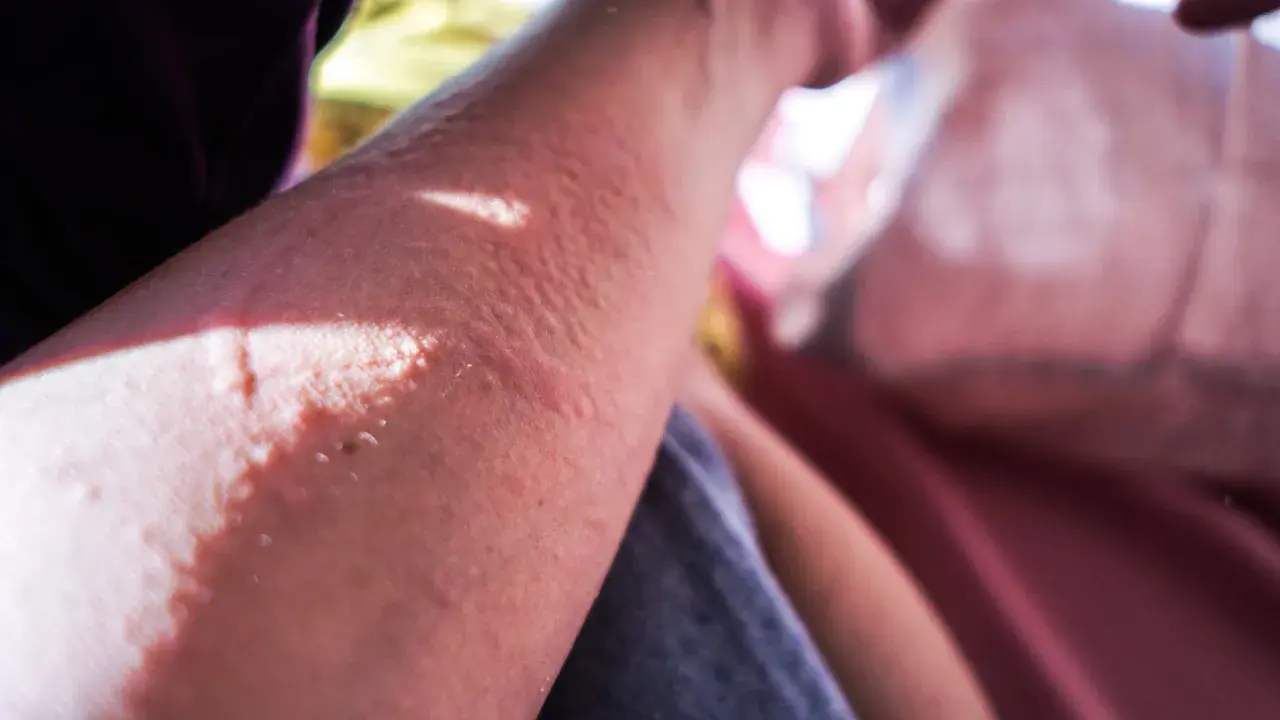 Brazo con erupción cutánea y ampollas, indicando una posible reaccion alergica al sol.