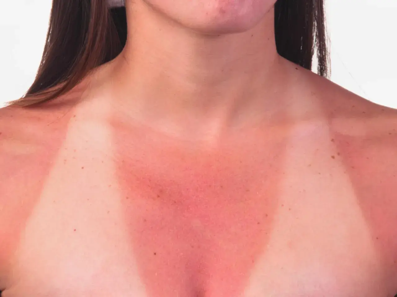 Piel enrojecida y quemada por el sol en el pecho y hombros, mostrando el resultado de qué pasa si te echas crema solar caducada.
