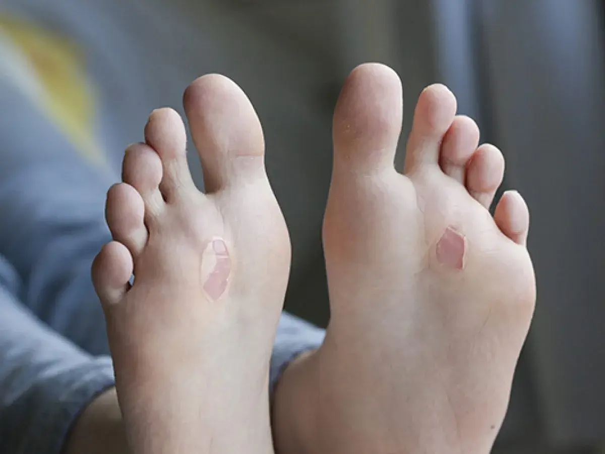 Pies con ampollas de sangre, resultado de una larga caminata.