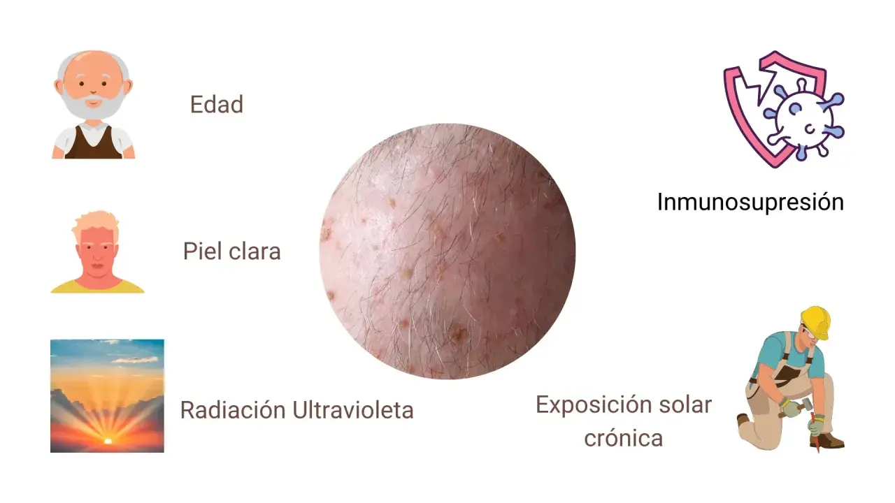 Lesiones en la piel que sugieren queratosis actínica, asociadas a edad, piel clara, radiación UV e inmunosupresión.