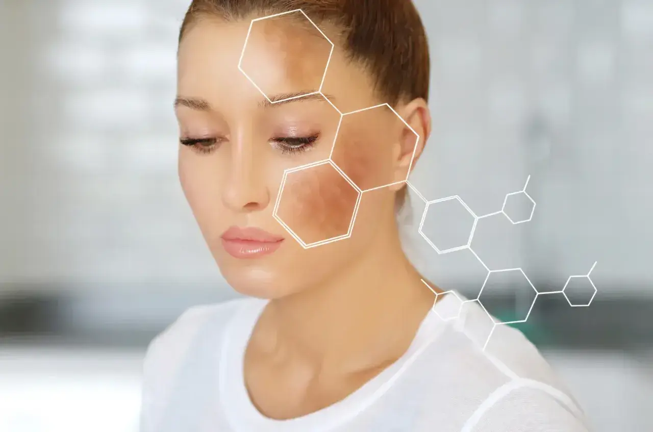 Rostro de mujer con manchas oscuras, ilustrando la melanina que es el pigmento de la piel. Estructura molecular superpuesta.