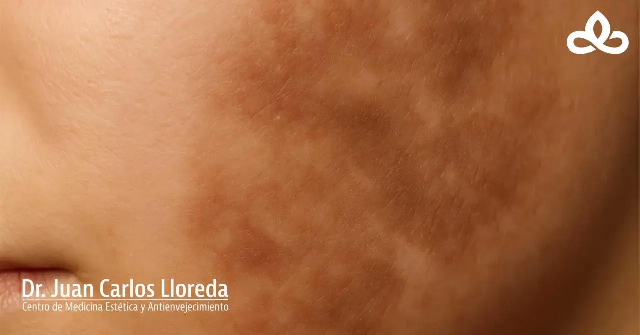 Piel con hiperpigmentación postinflamatoria, mostrando manchas oscuras y textura irregular. Logo de Dr. Juan Carlos Lloreda.