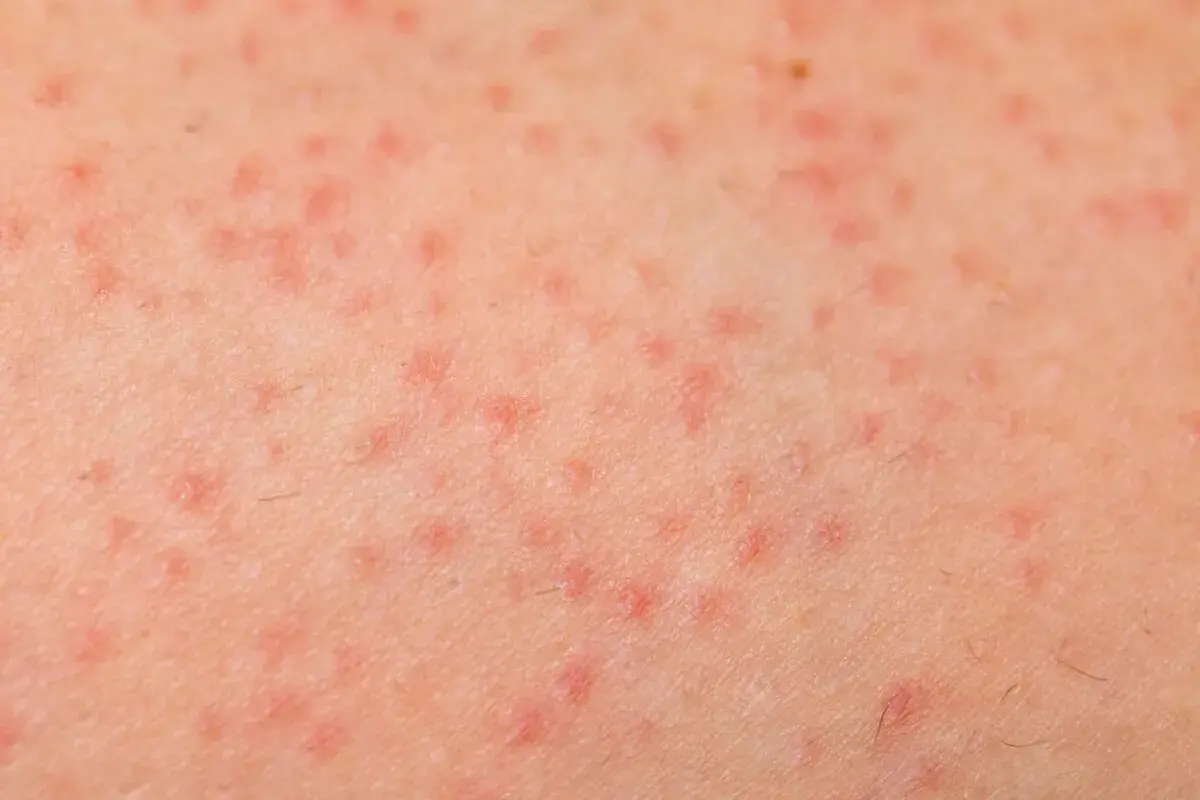 Piel con pequeñas protuberancias rojas y ásperas, indicativo de queratosis pilaris.