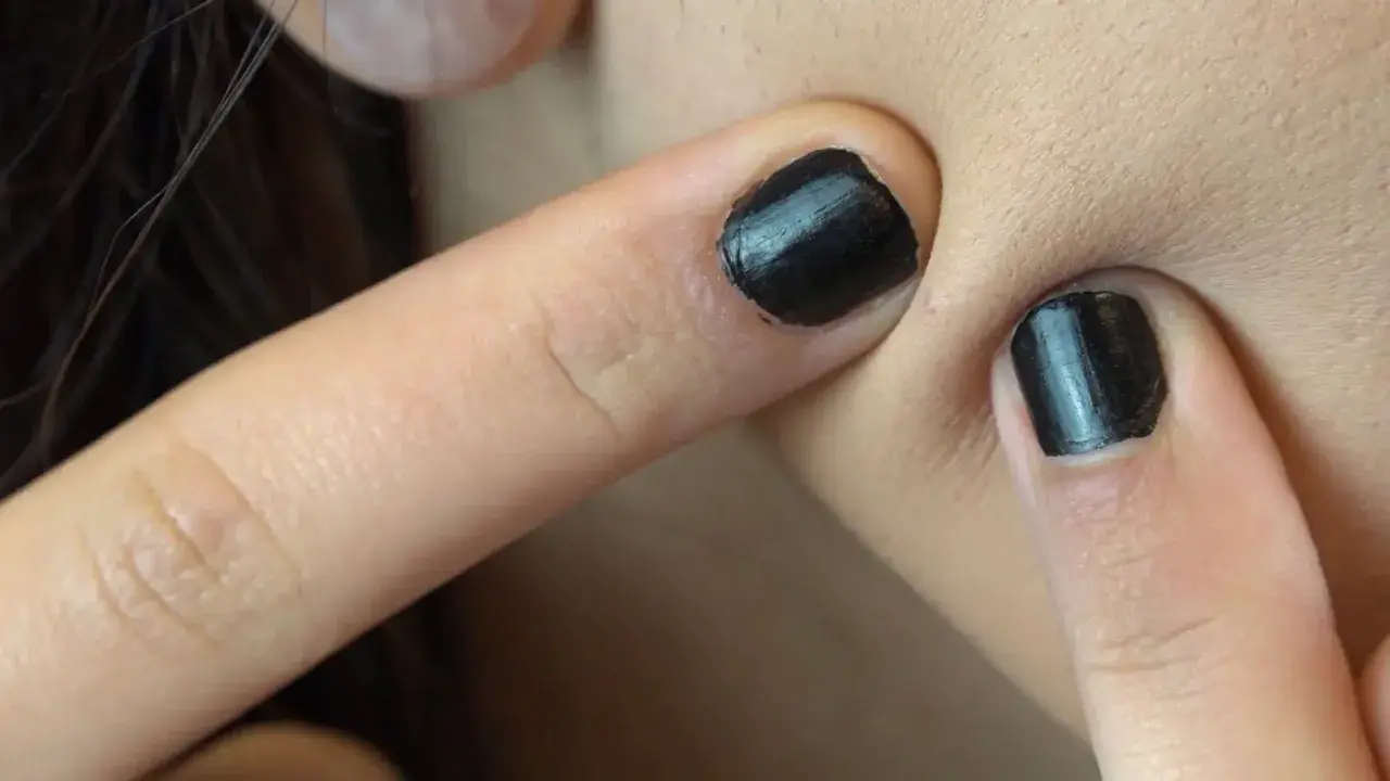 Dedos con uñas negras presionan la piel, listos para explotar granos.